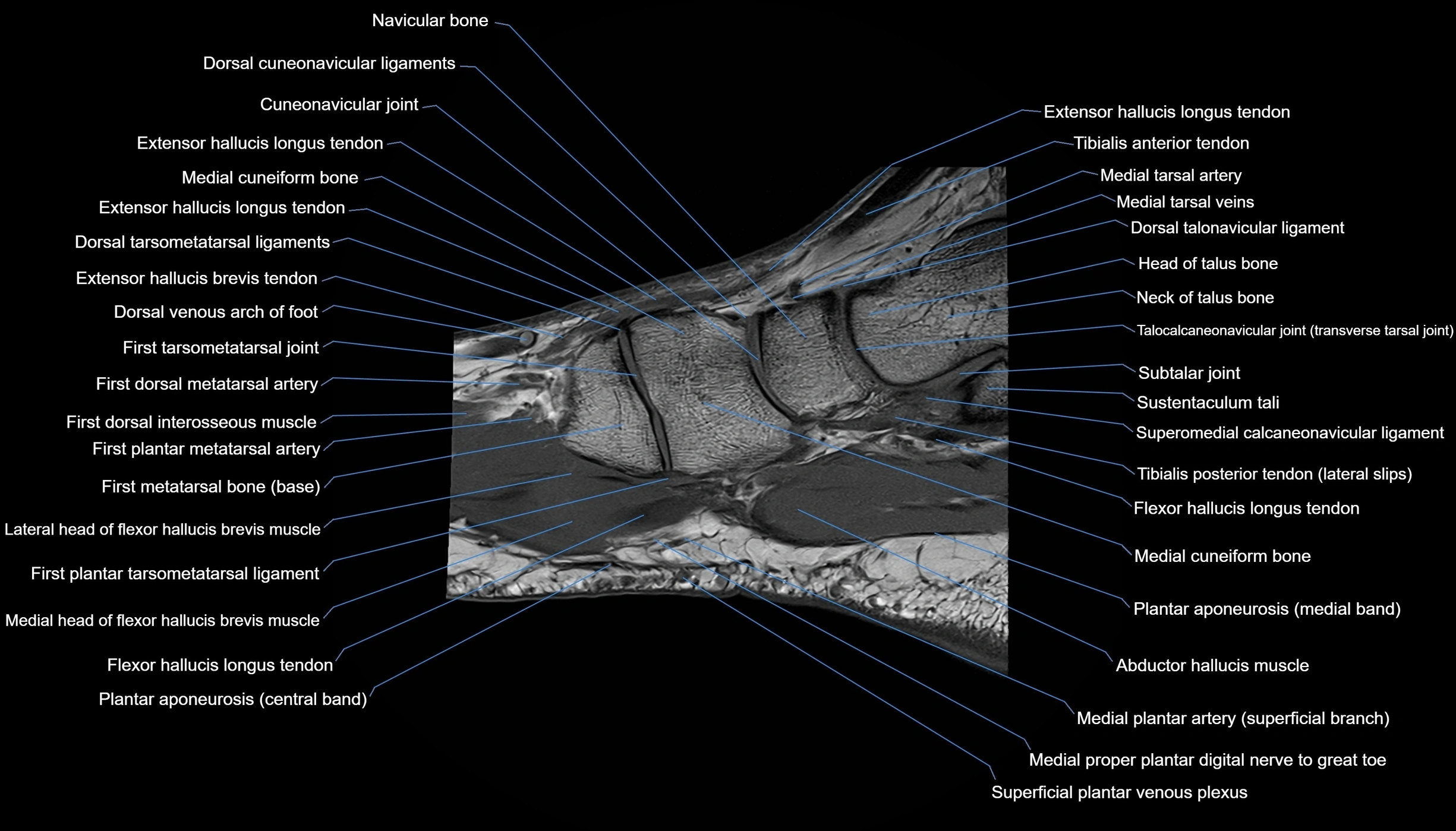 MRI mid foot sagittal cross sectional anatomy 3T  radiology  image-img-00001-00030.webp